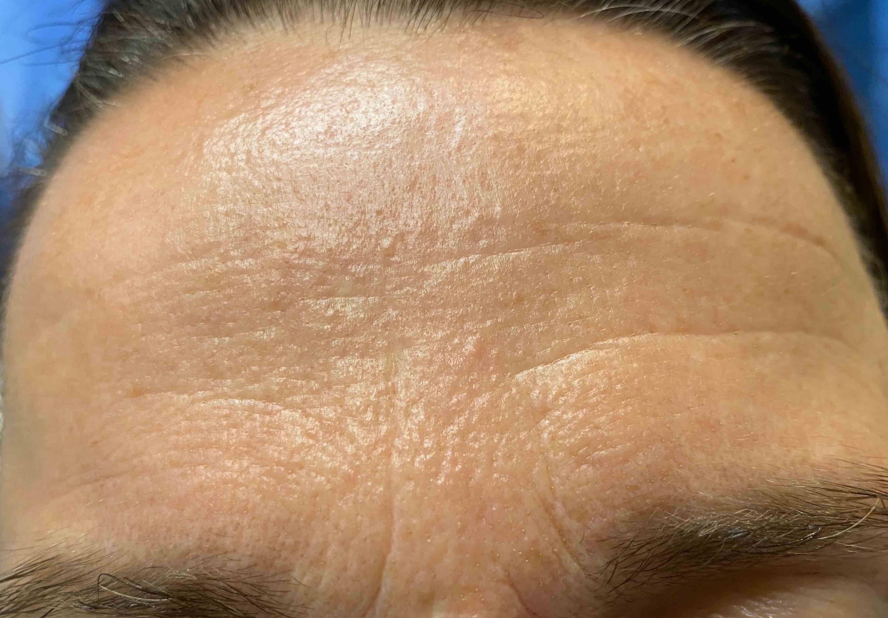 Exosomes (1 Treatment) 1 Before