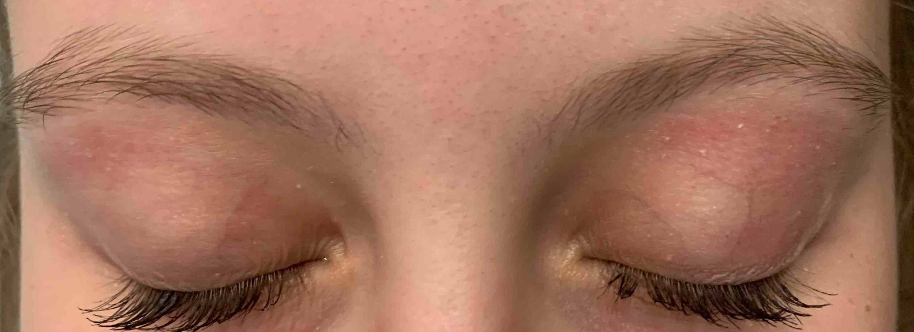 Eczema Before and After Case 17 After