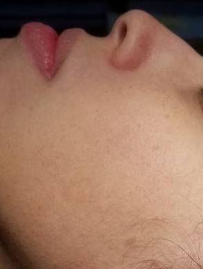 IPL-Photofacial/BBL Before and After Case 8 After