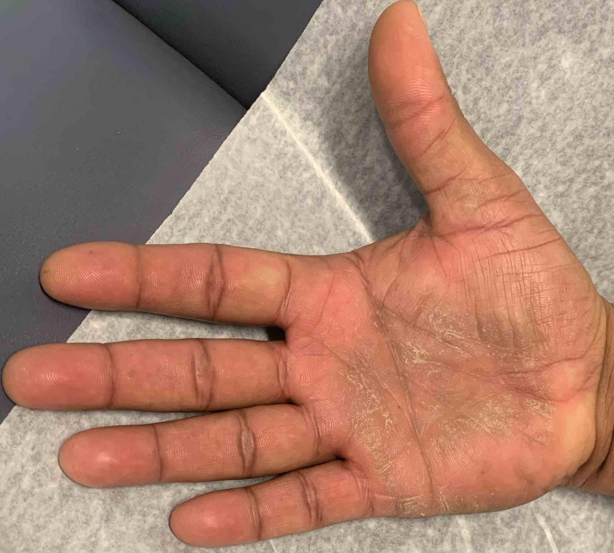 Psoriasis Before and After Case 31 After