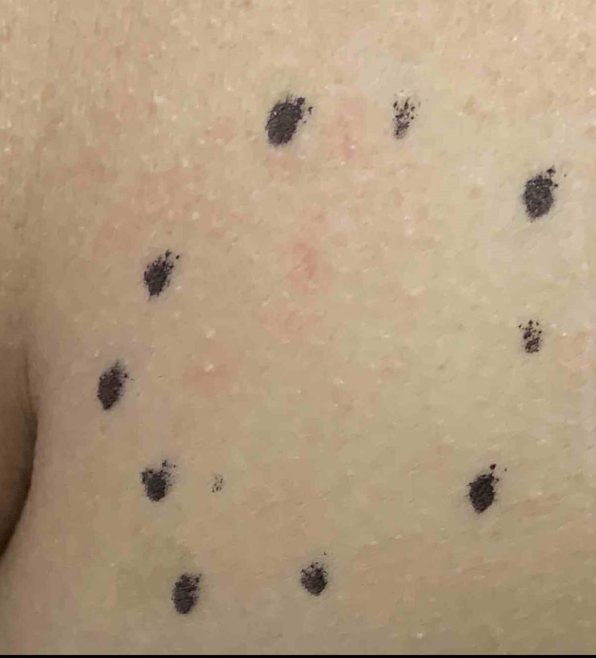 Lipoma Before and After 3 Before