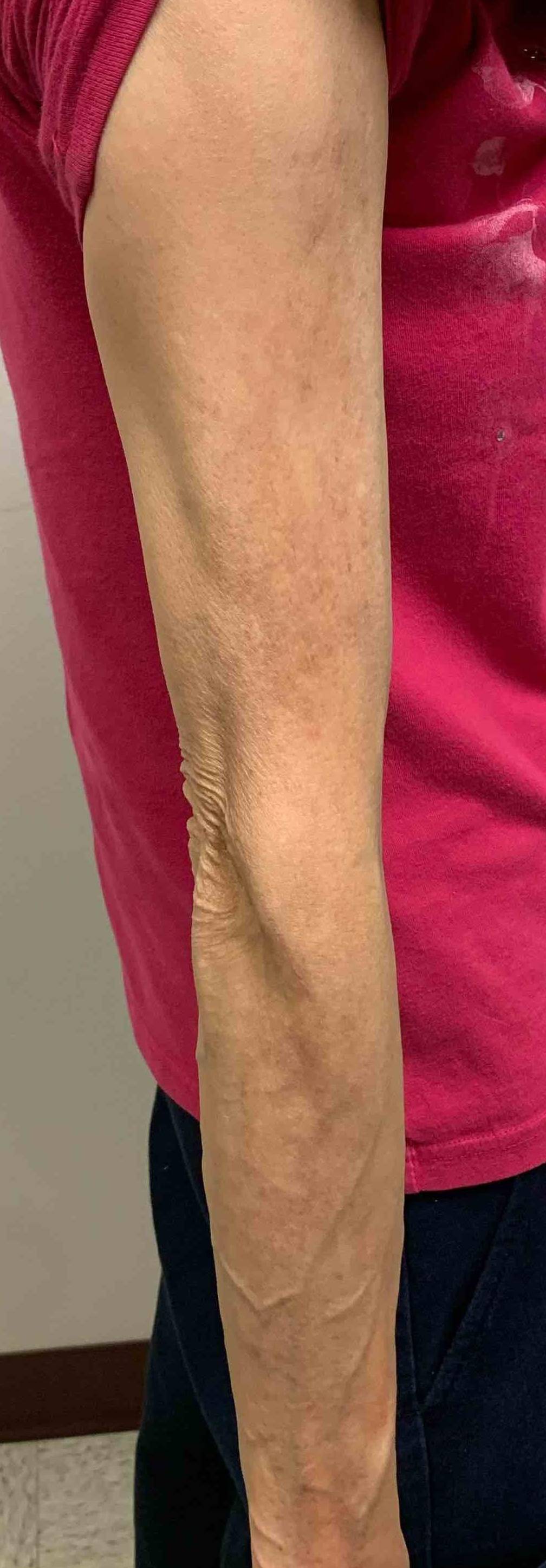 Atopic Dermatitis Before and After 19 After