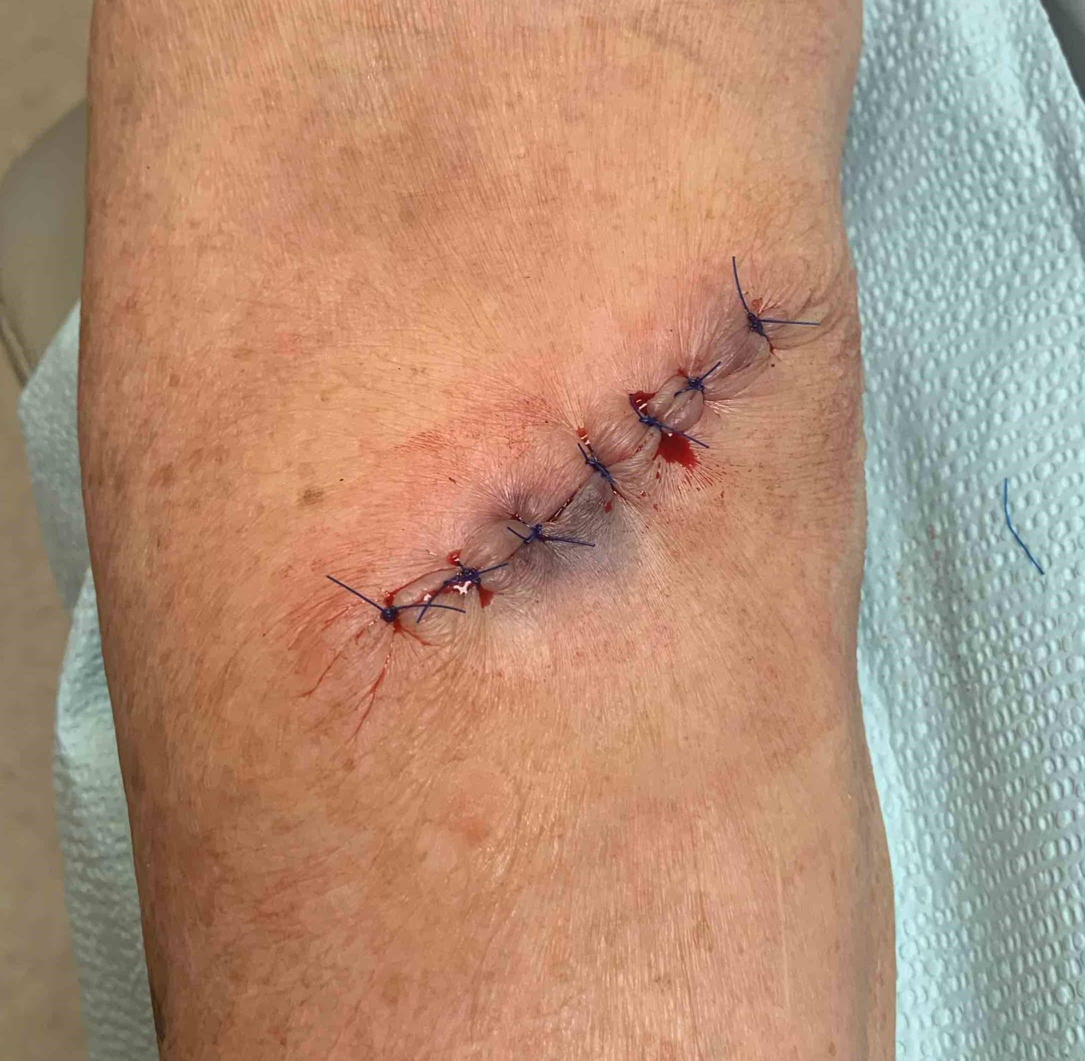 Cyst Removal Before and After Case-7 After
