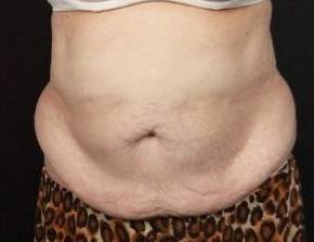 CoolSculpting<sup>®</sup> Before and After Case 8 After