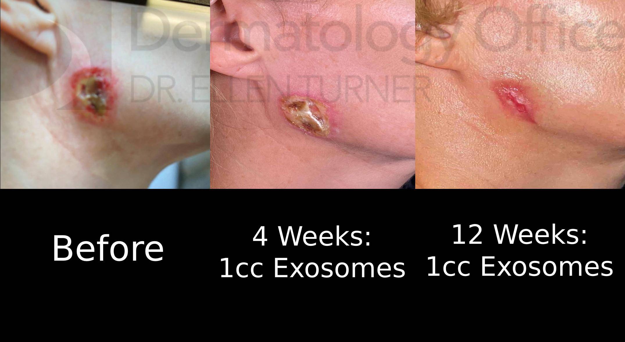 Exosomes Before and After 