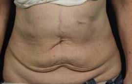 CoolSculpting<sup>®</sup> Before and After Case 11 After