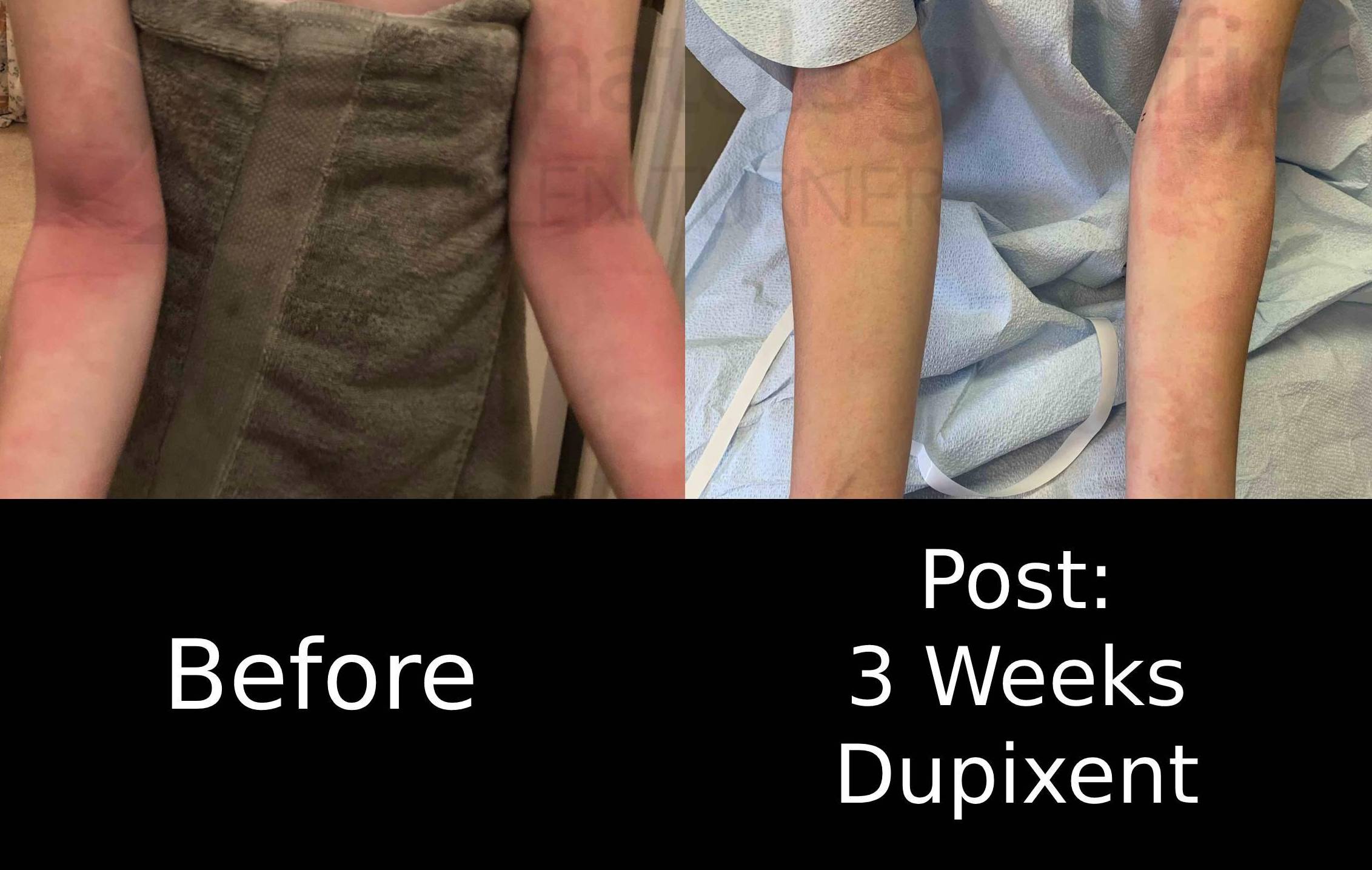 Eczema/ Atopic Dermatitis (3 Weeks Dupixent) Case-21 