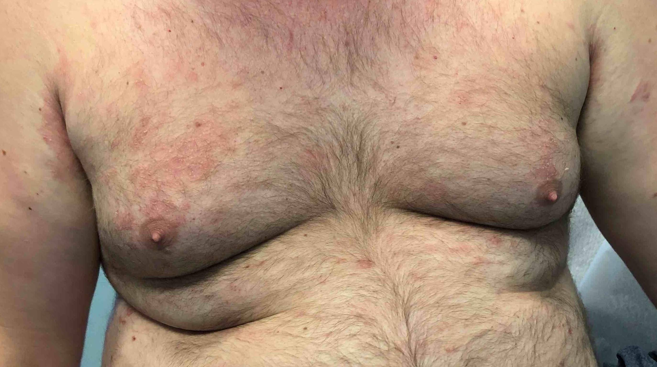 Allergic Contact Dermatitis Case-6 After