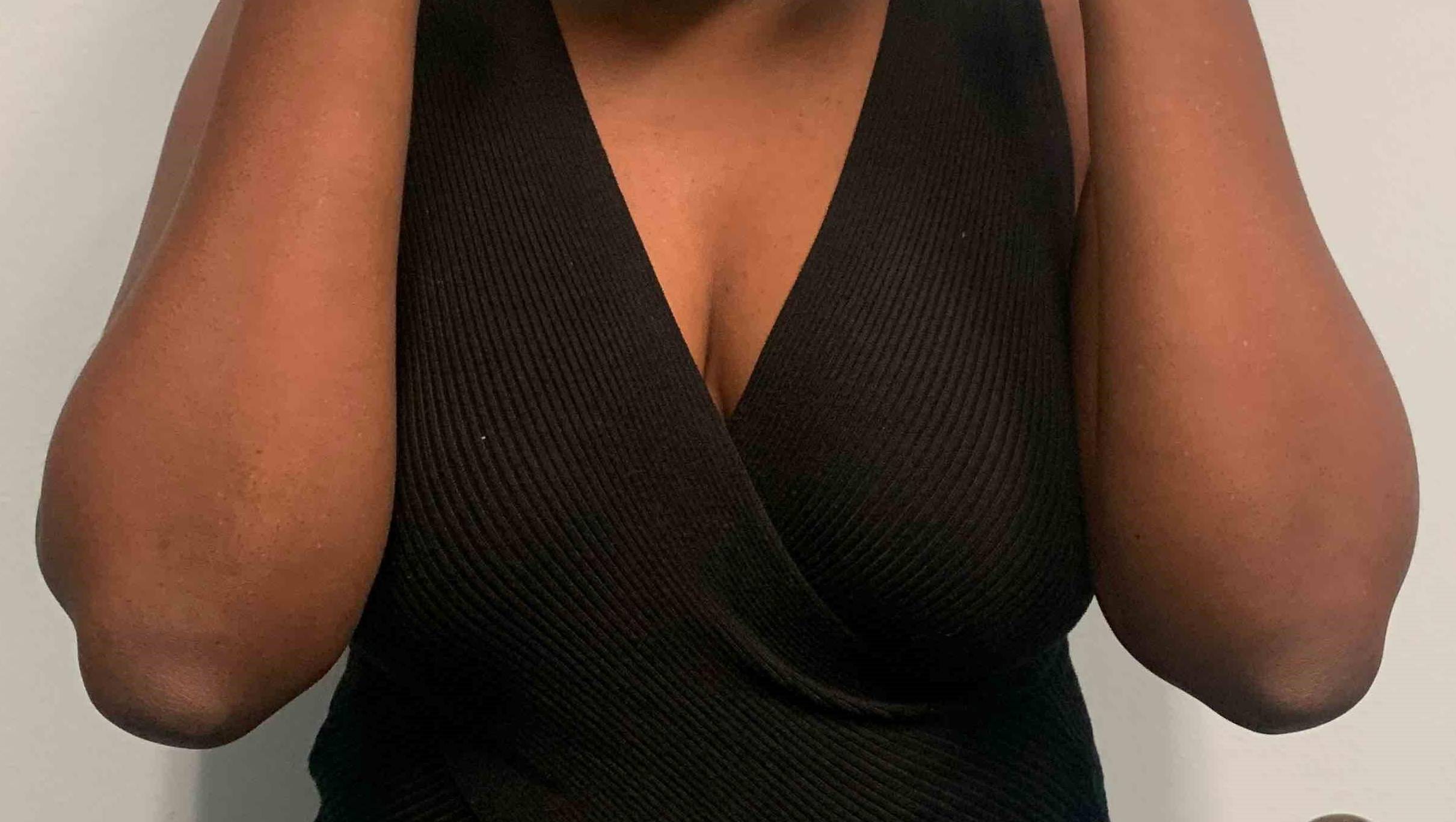 Allergic Contact Dermatitis Case-8 After