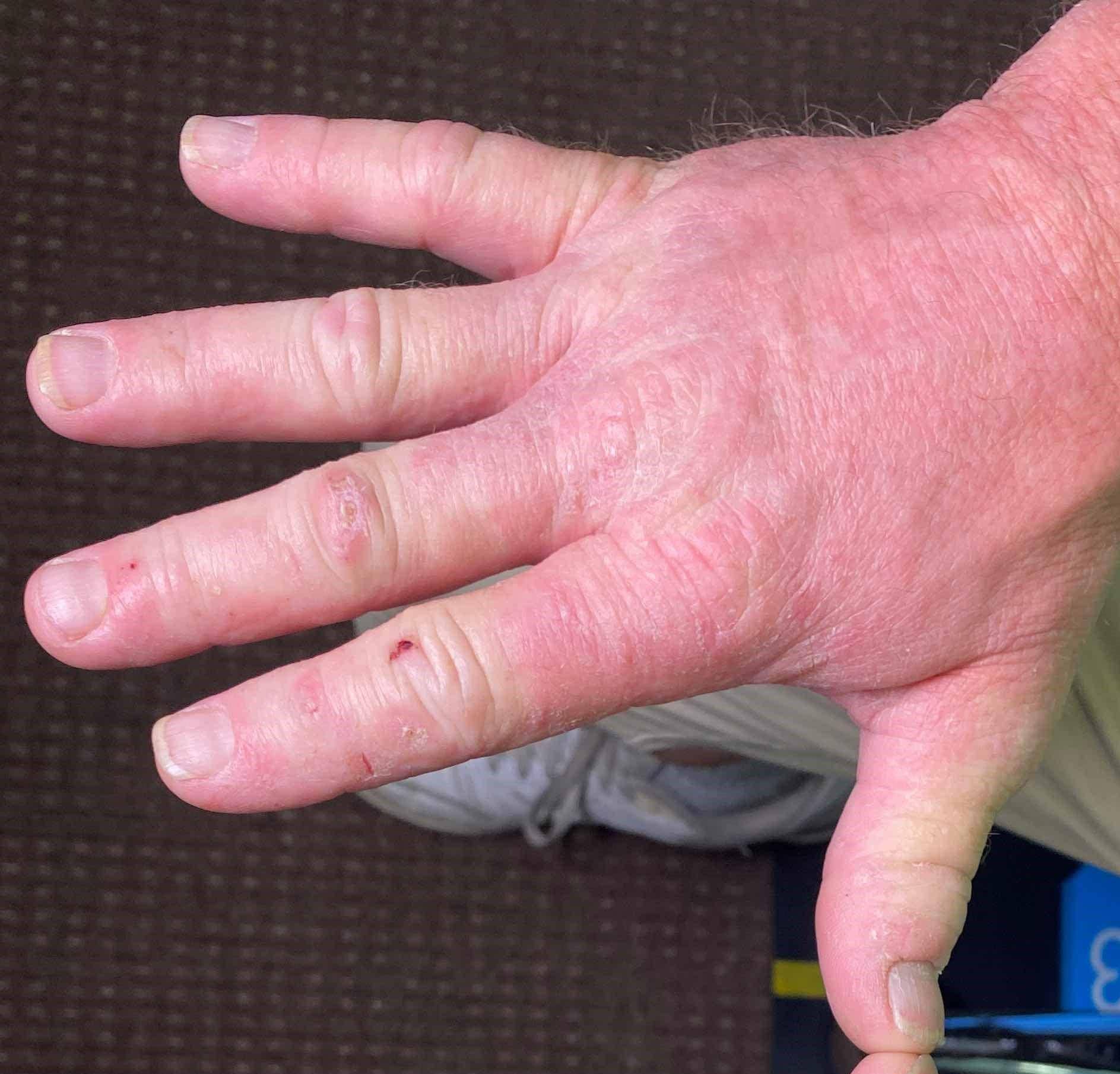 Allergic Contact Dermatitis Case-12 After
