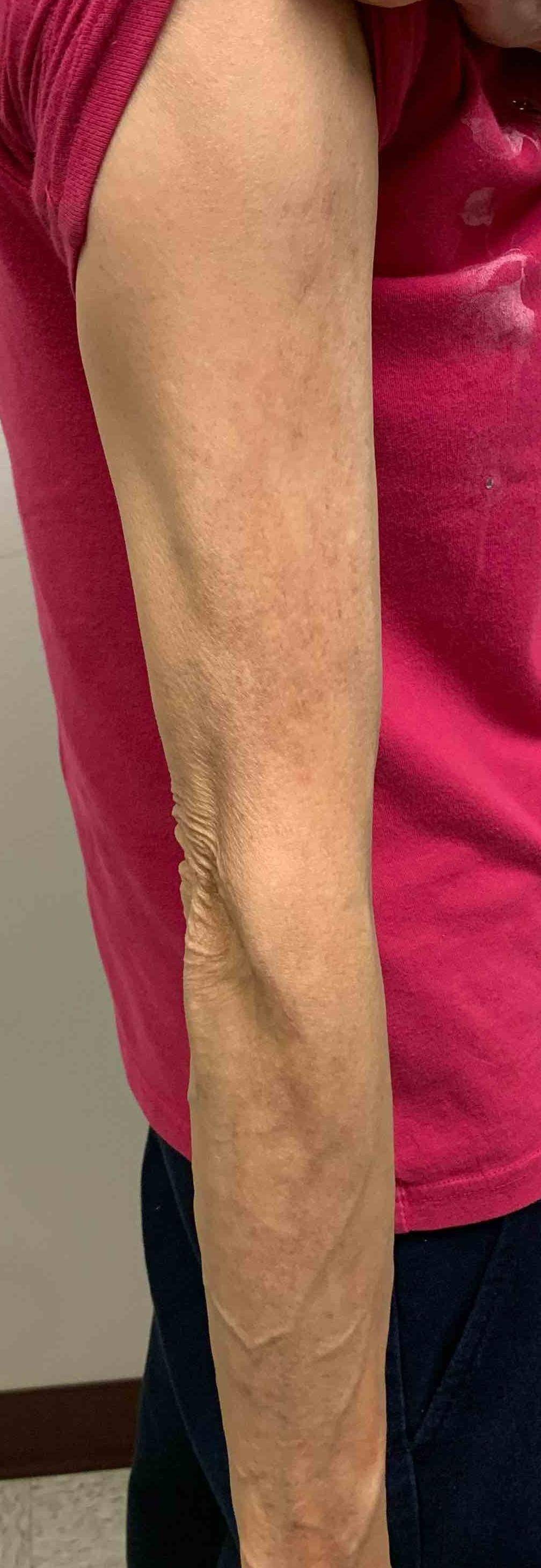 Allergic Contact Dermatitis Case-13 After