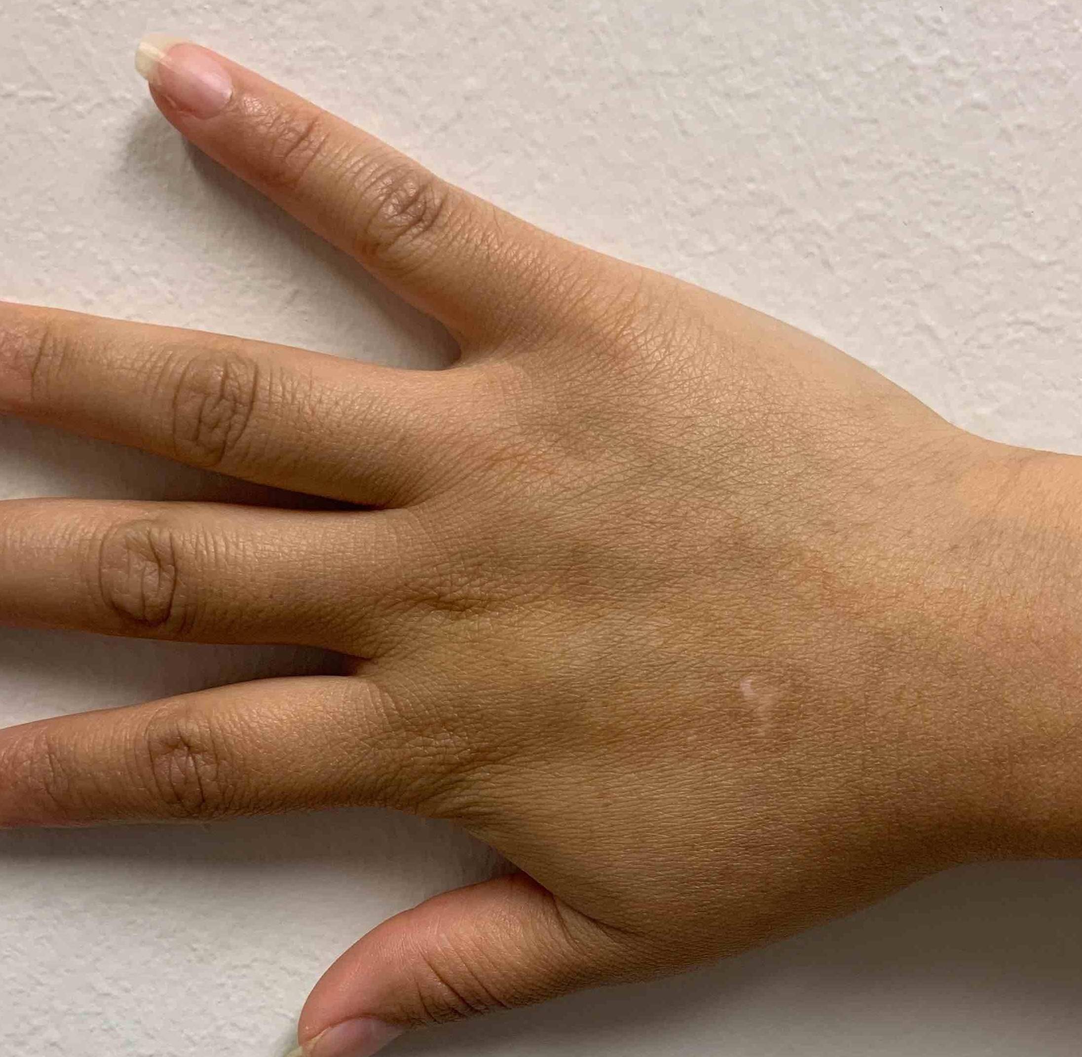 Vitiligo (6 mo Dupixent) Case-3 After
