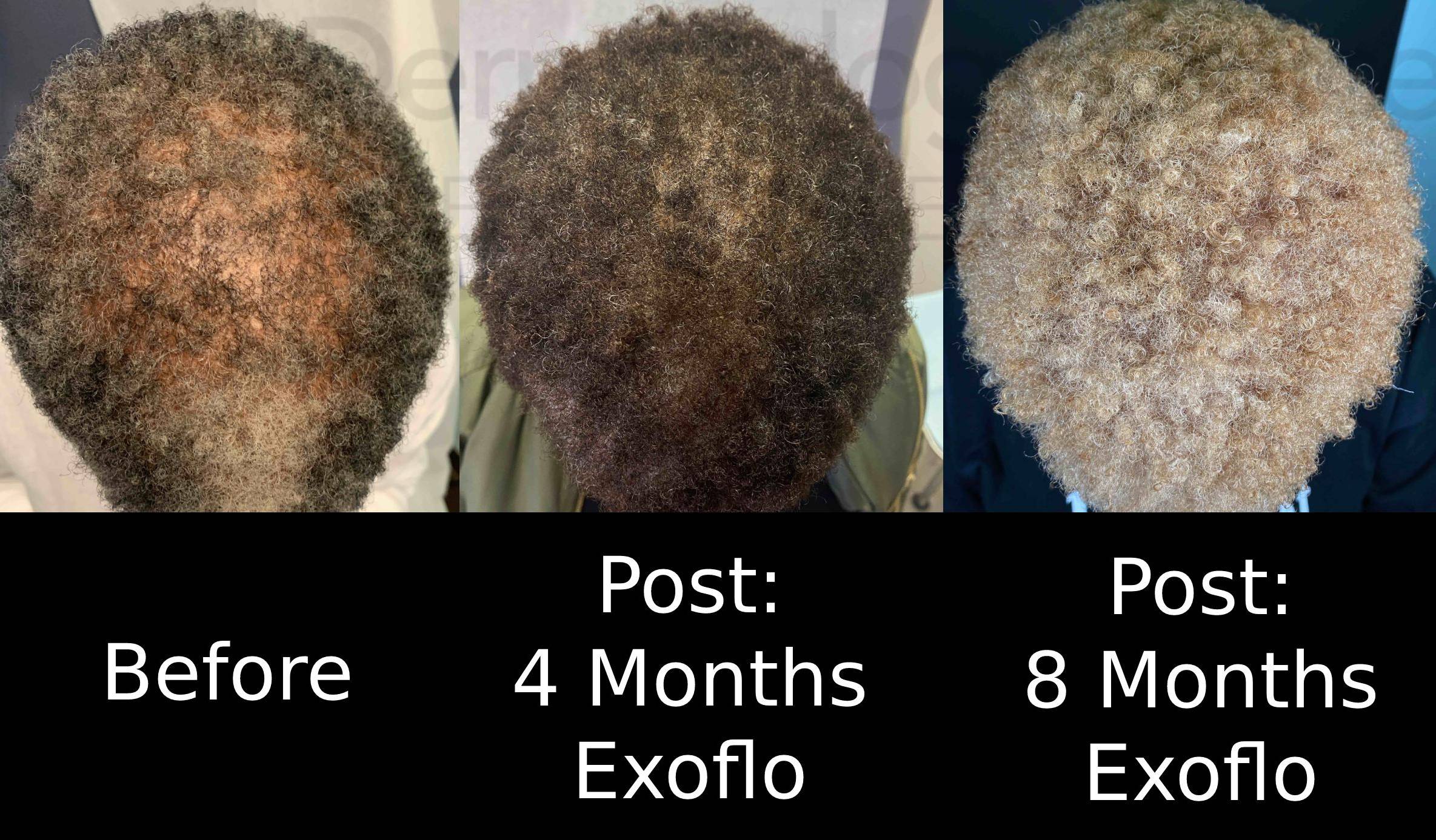 Hair Restoration Before and After Case 5 