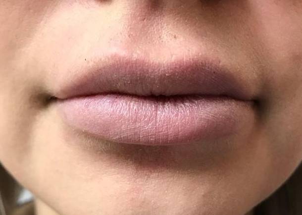 Juvederm (1 Syringe) Case-28 After