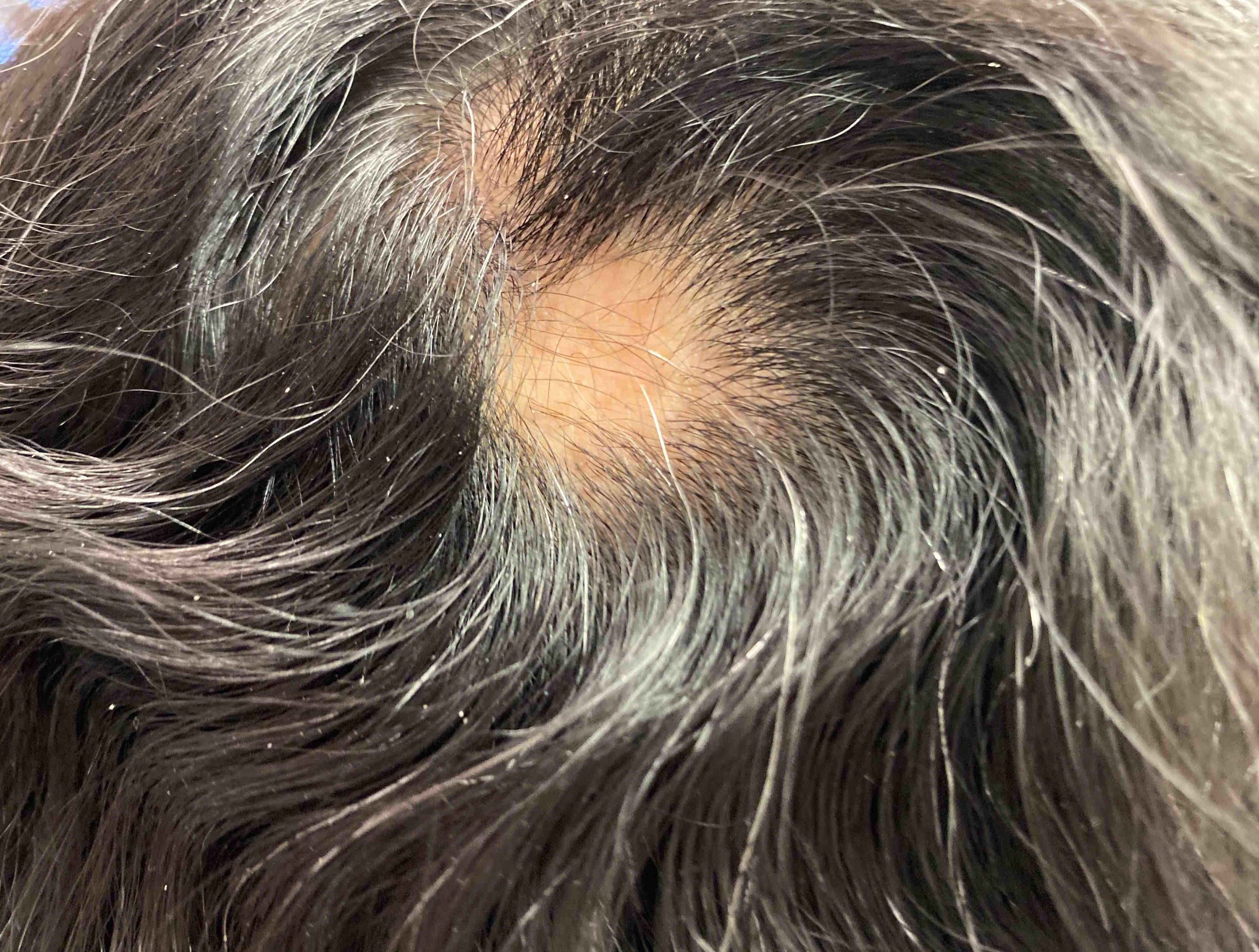 Hair loss Before and After Case 10 Before