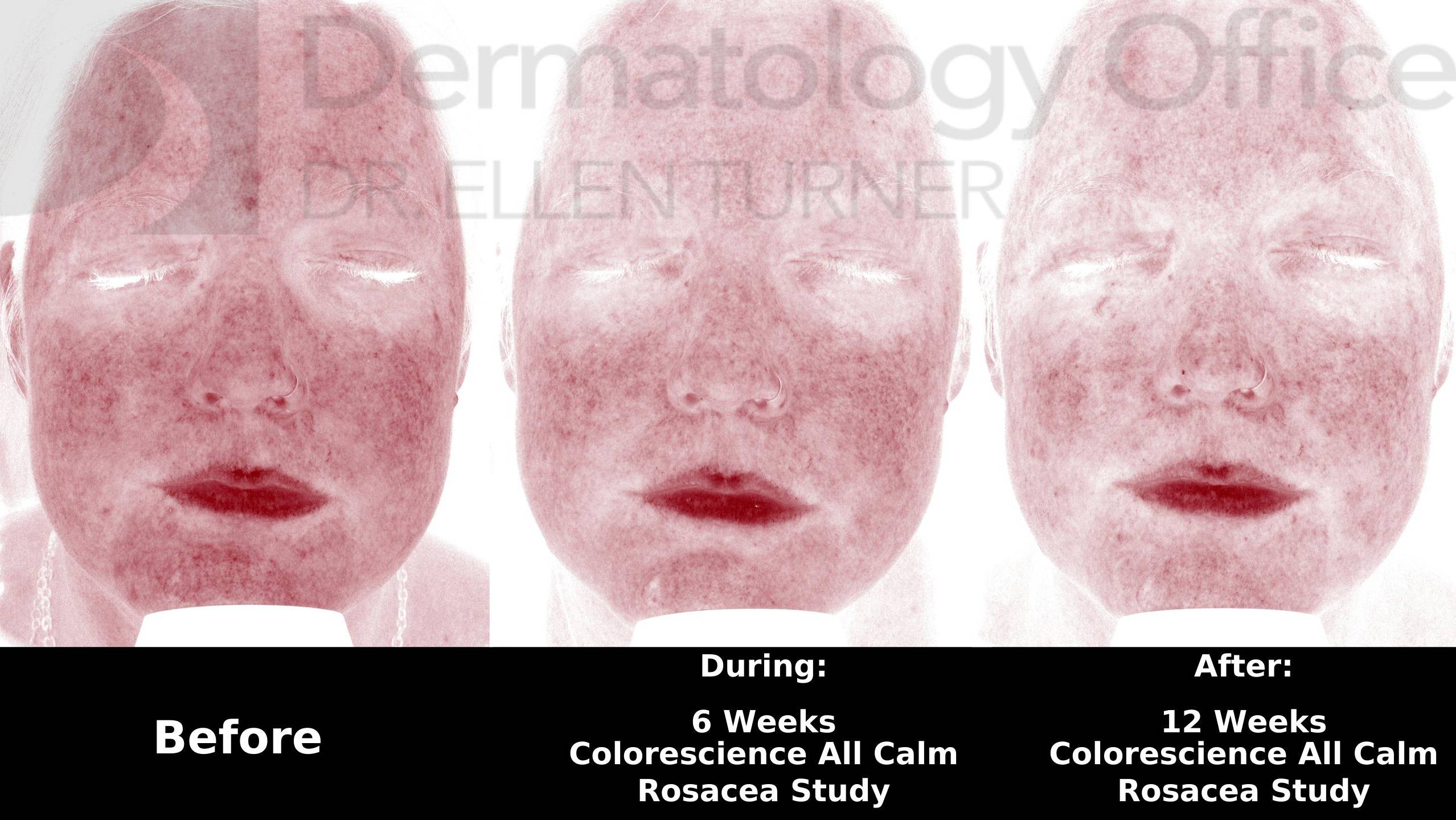 Colorescience Rosacea Study Case-7 