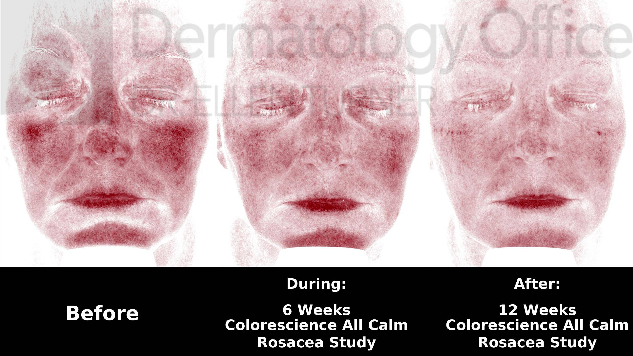 Colorescience Rosacea Study Case-13 
