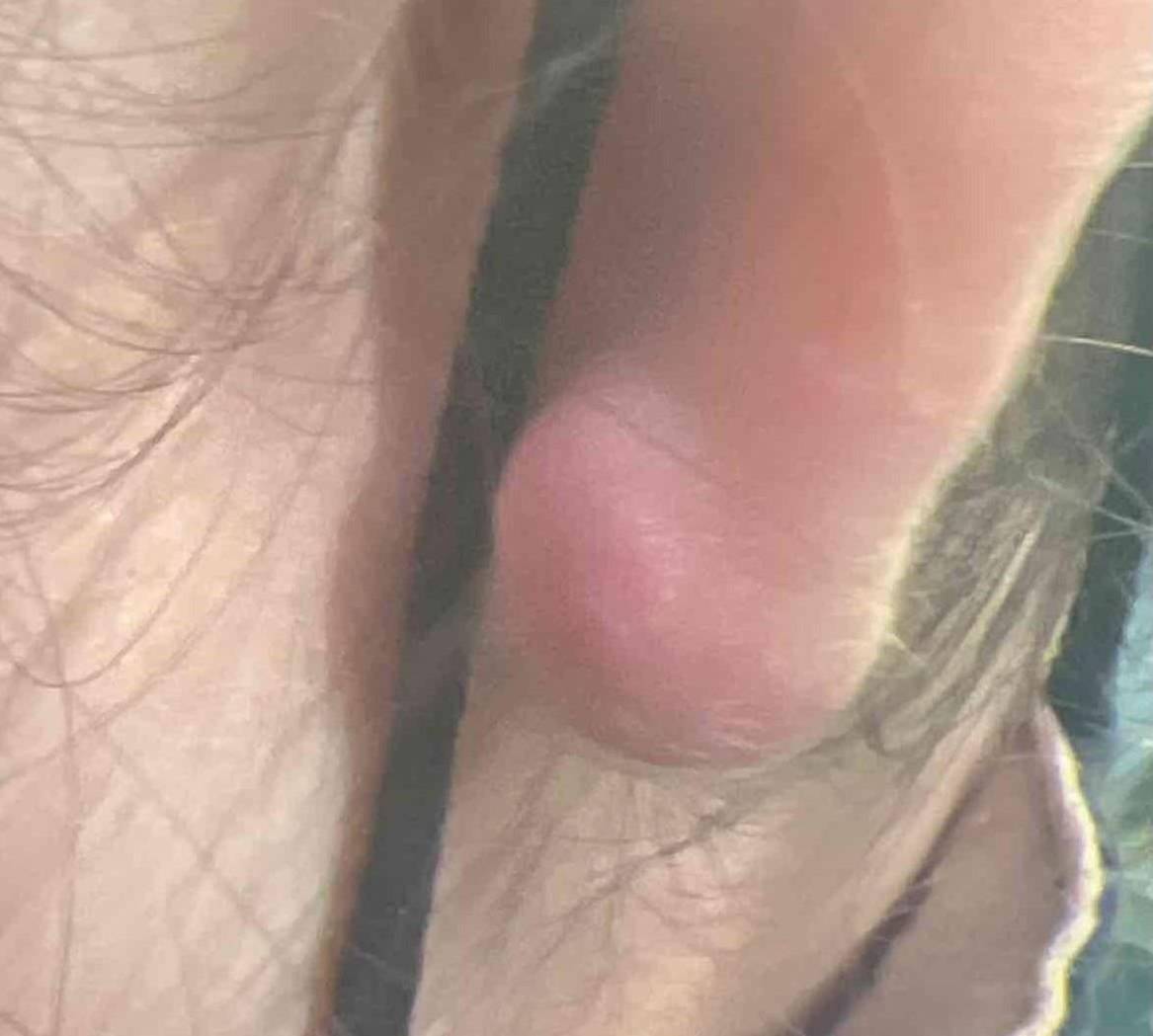 Keloids Before and After Before