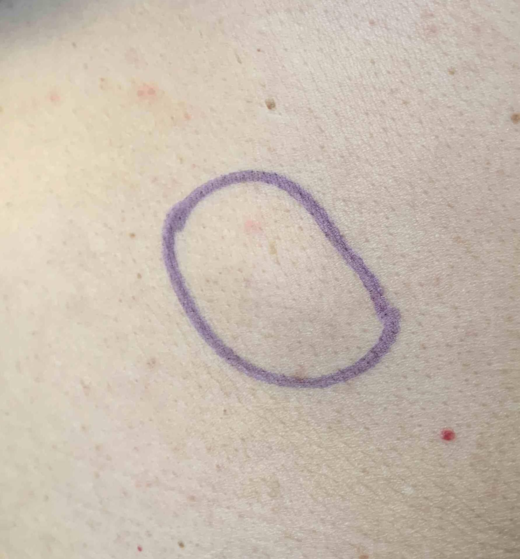 Lipoma Before and After Case-4 Before
