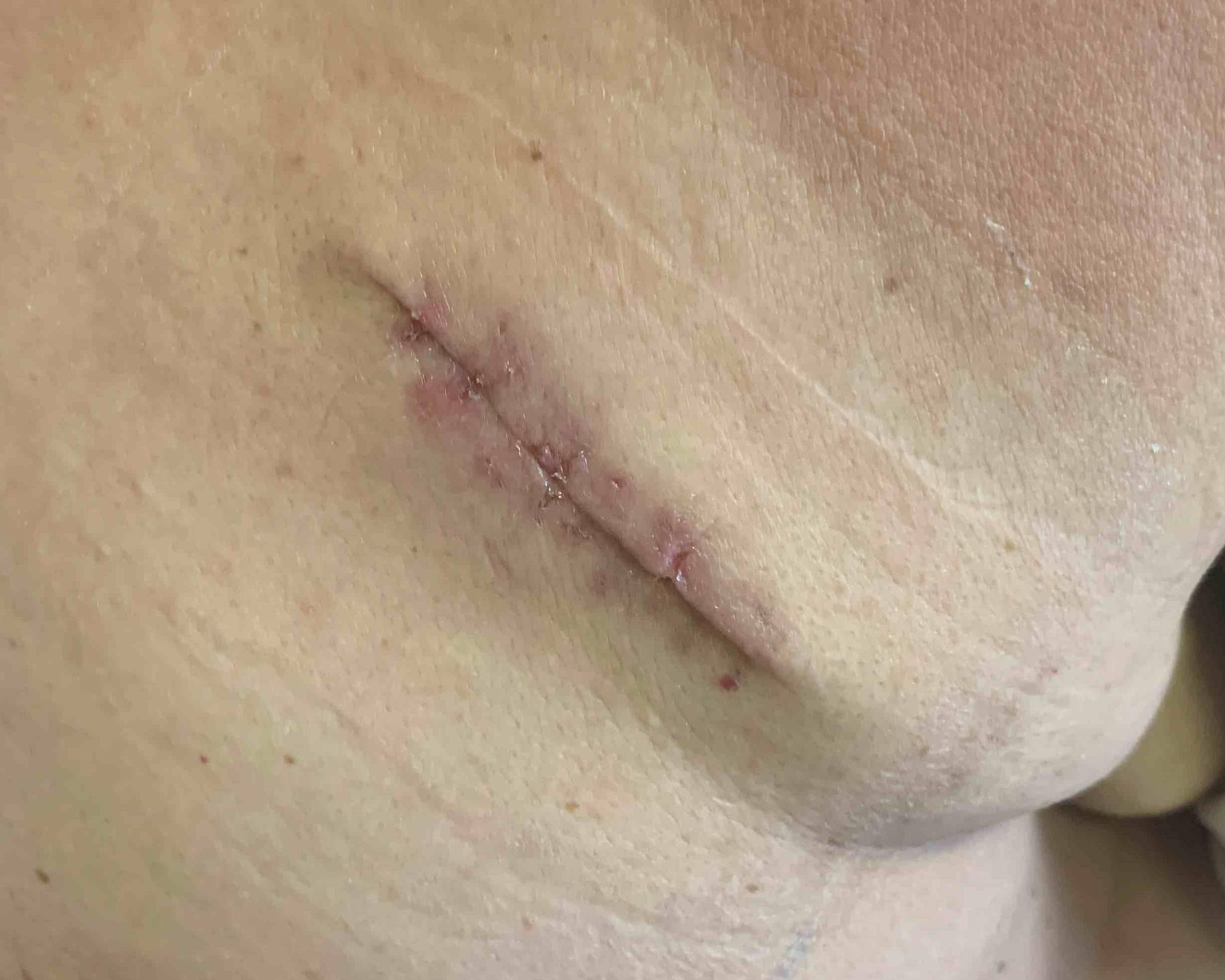 Lipoma Before and After Case-4 After