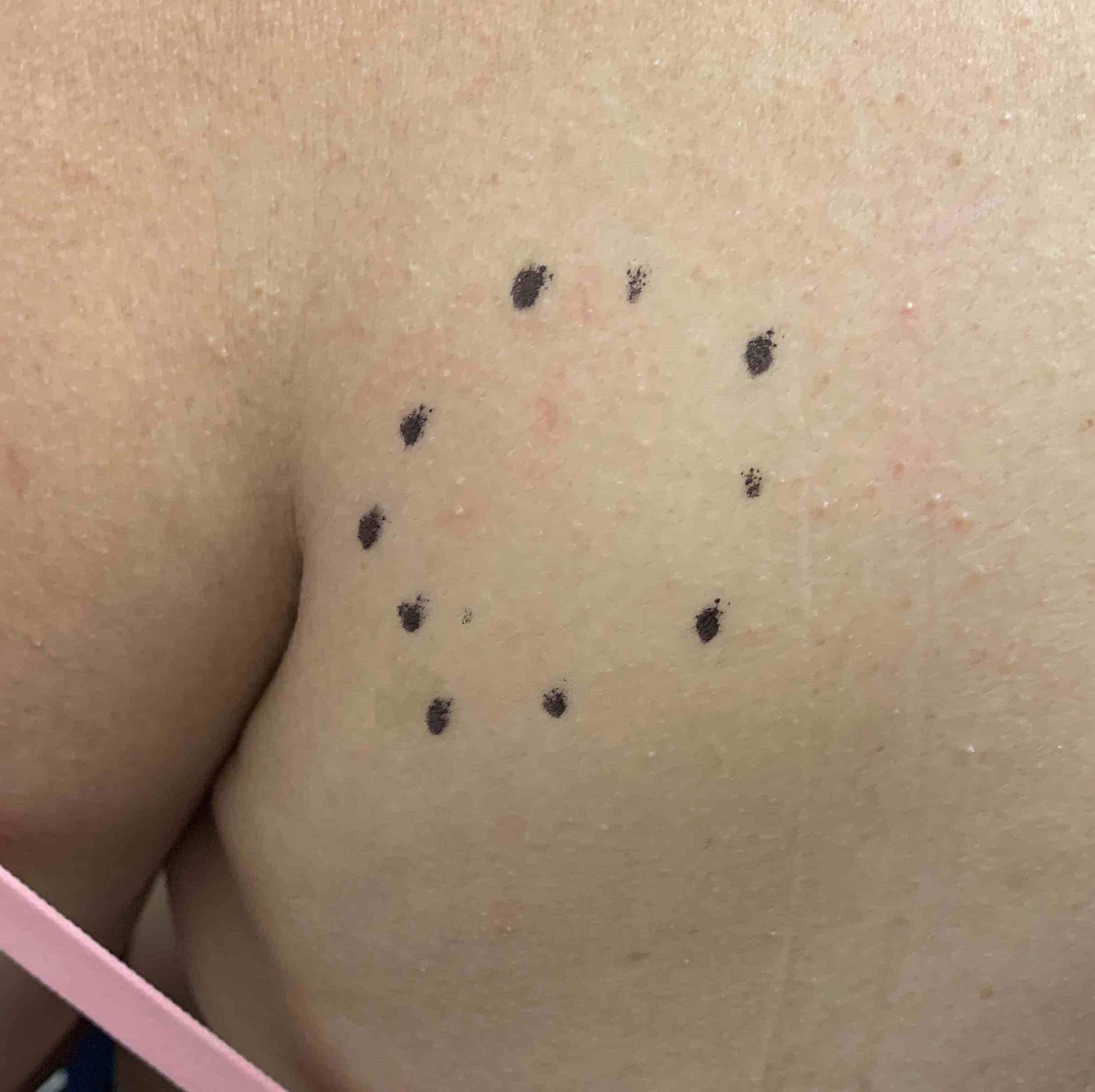 Lipoma Before and After Case-5 Before