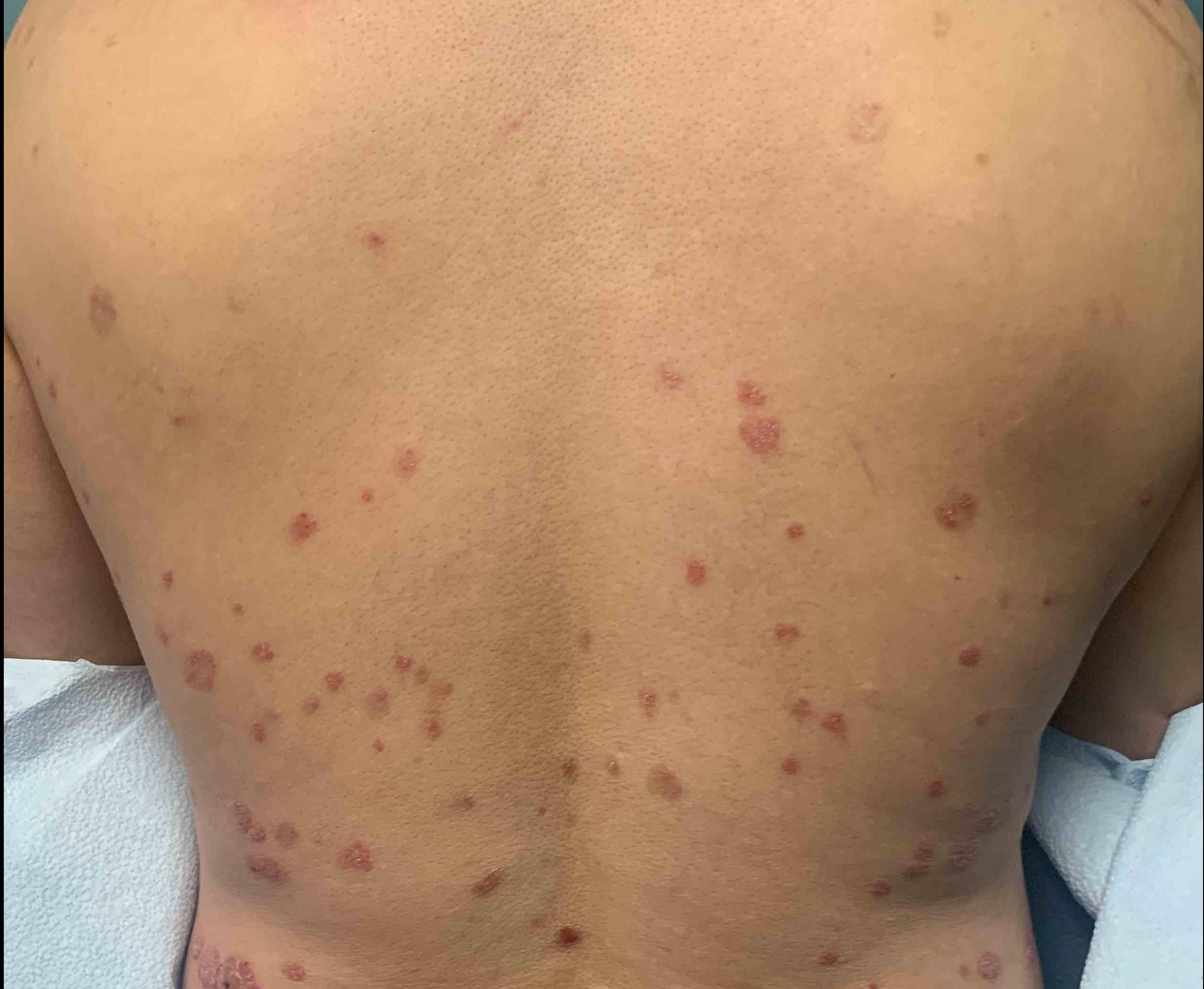 Psoriasis (3 Month Cosentyx) Case-39 Before