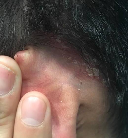 Psoriasis (6 Month Taltz) Case-42 Before