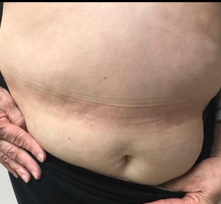 Psoriasis (6 Month Cosentyx) Case-44 After