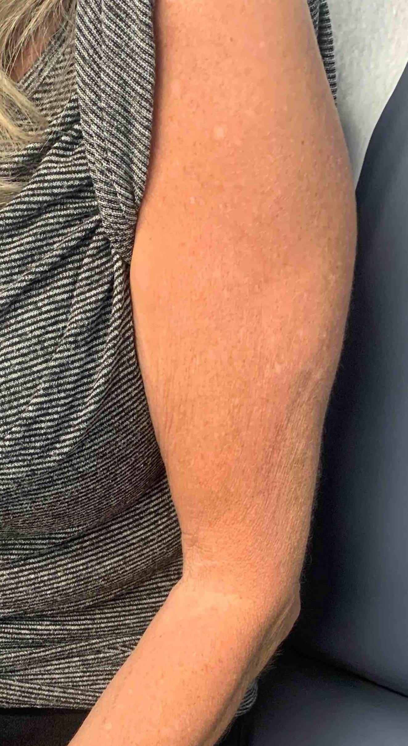 Psoriasis (6 Month Taltz) Case-45 After