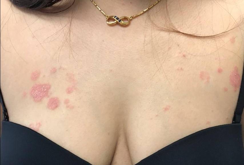 Psoriasis (6 Month Cosentyx) Case-57 Before