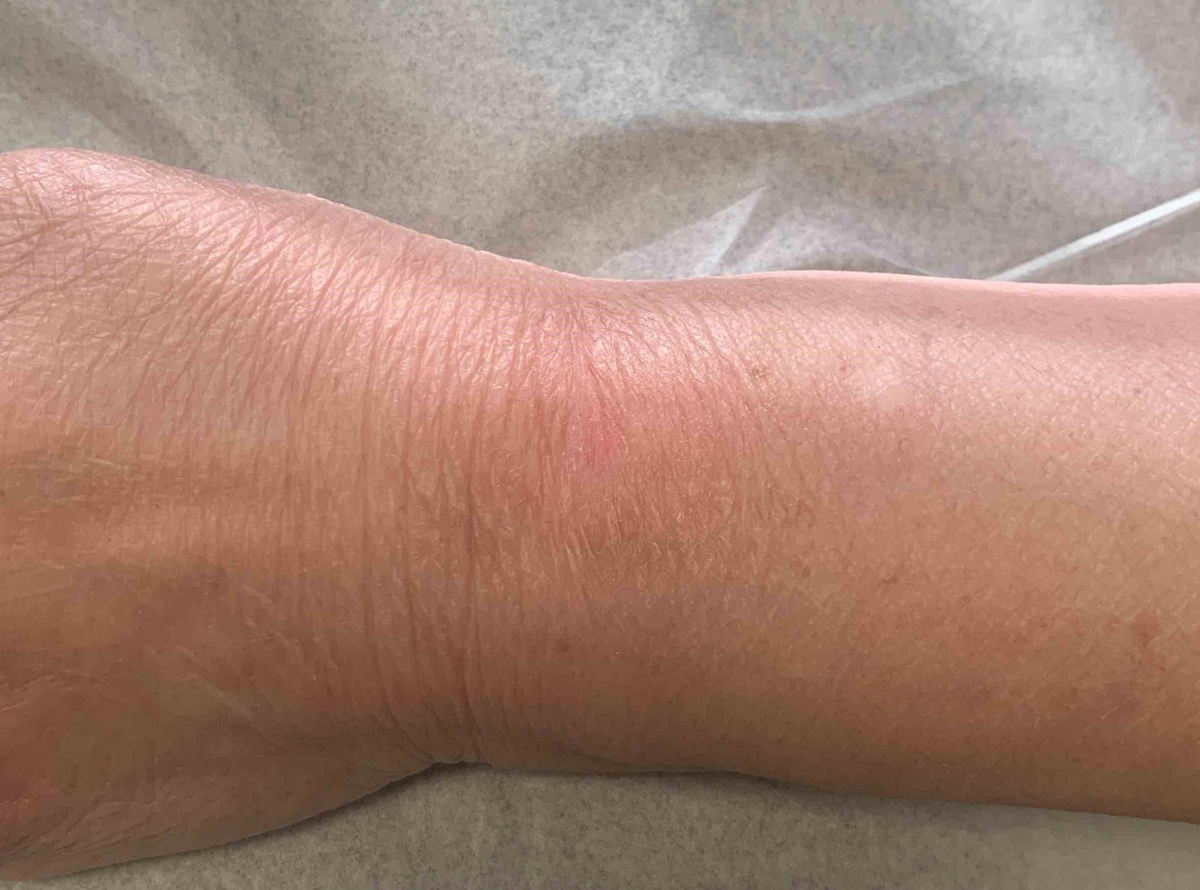 Skin Cancer (14 Radiation Treatment) Case-51 After