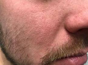 Eczema Before and After Case 3 After