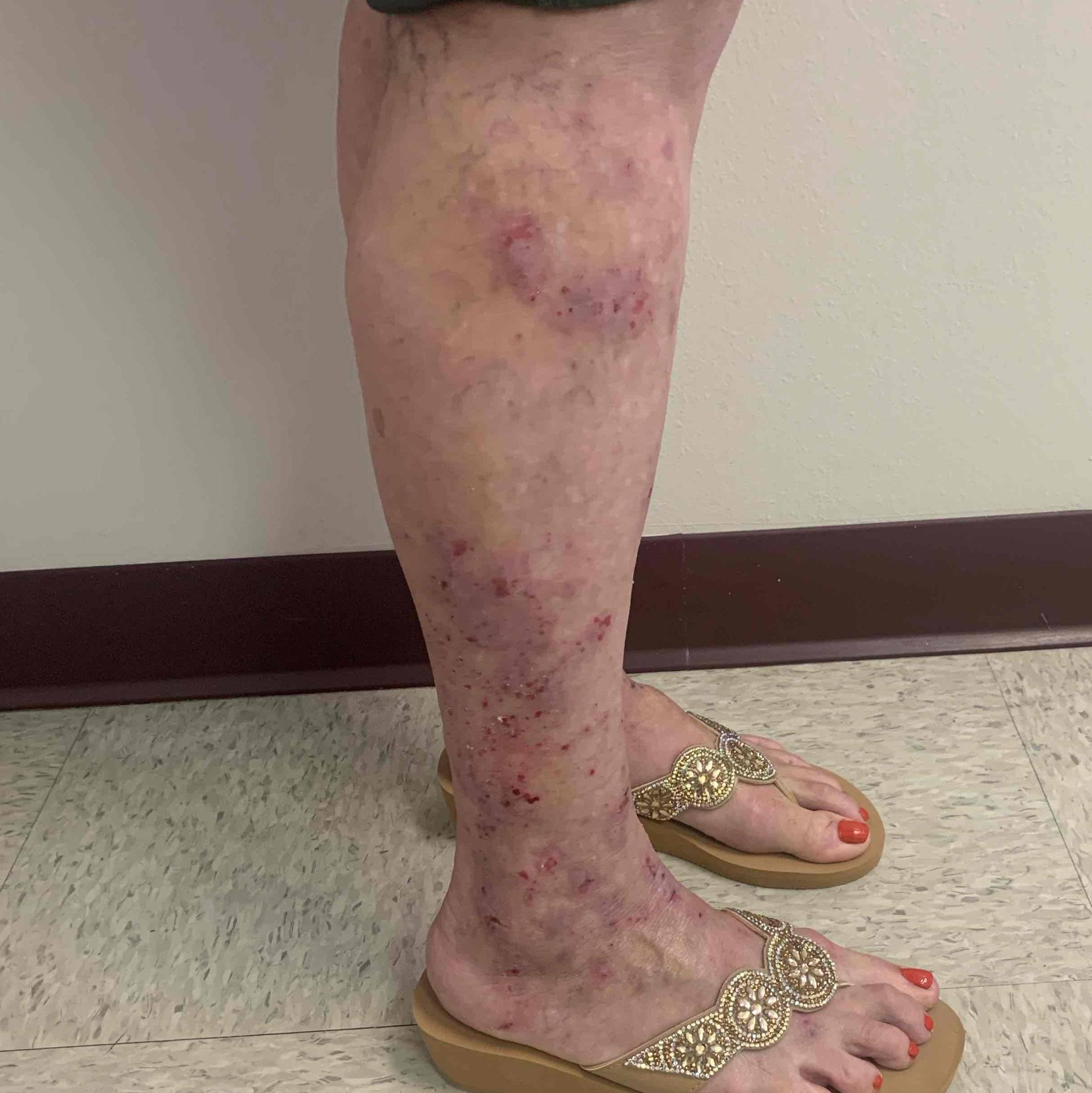 Atopic Dermatitis Before and After Case-35 Before