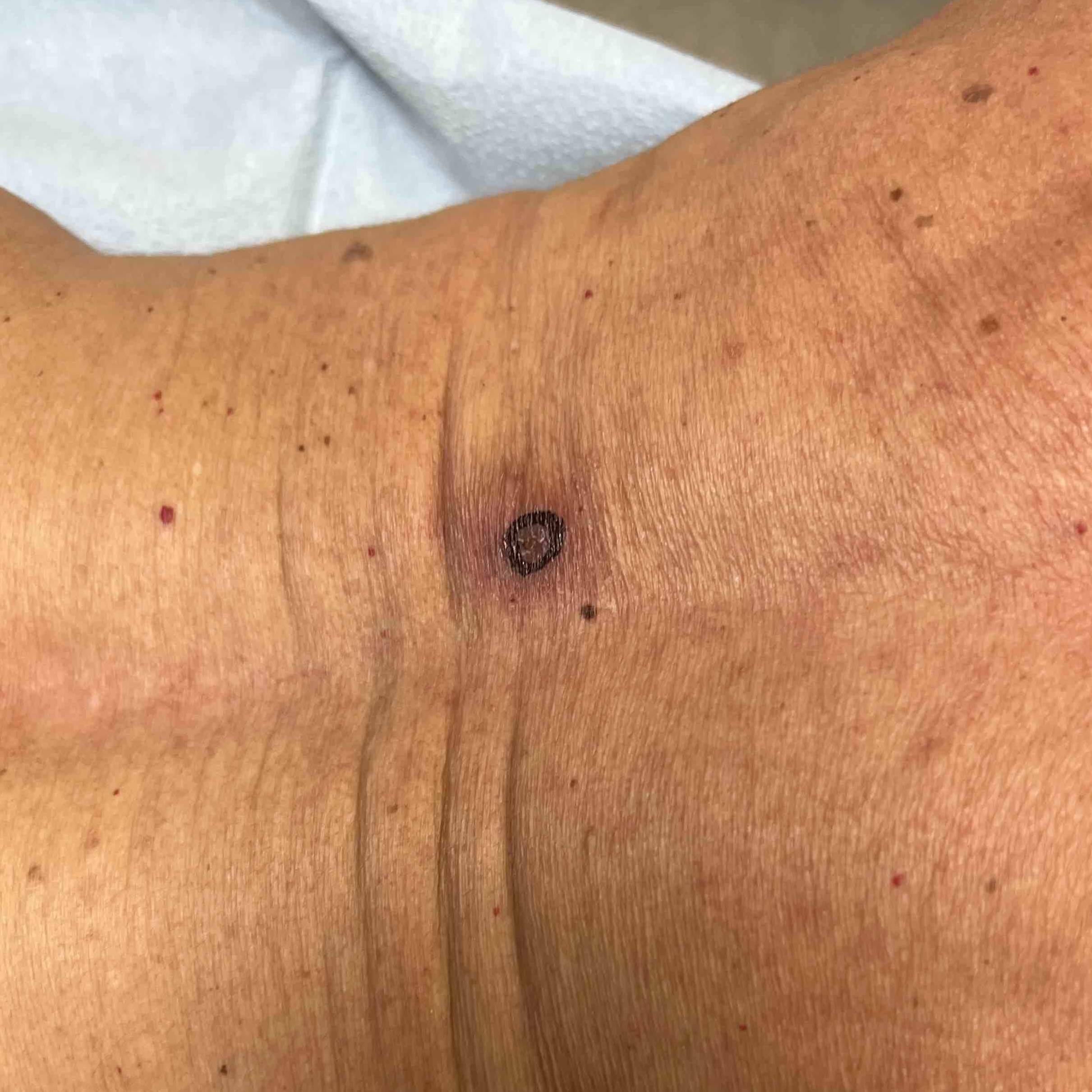 Cyst Removal Before and After Case-18 Before