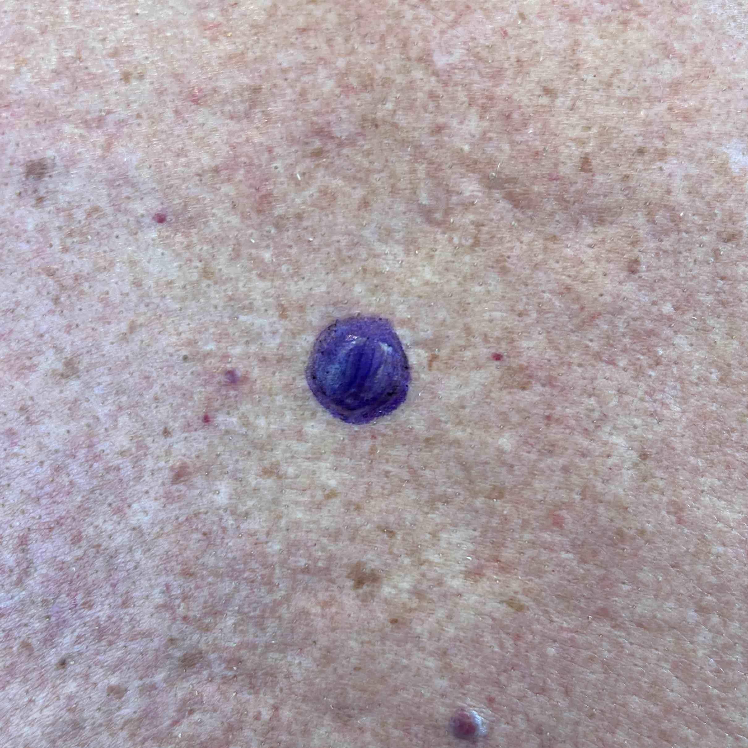 Cyst Removal Before and After Case 20 Before