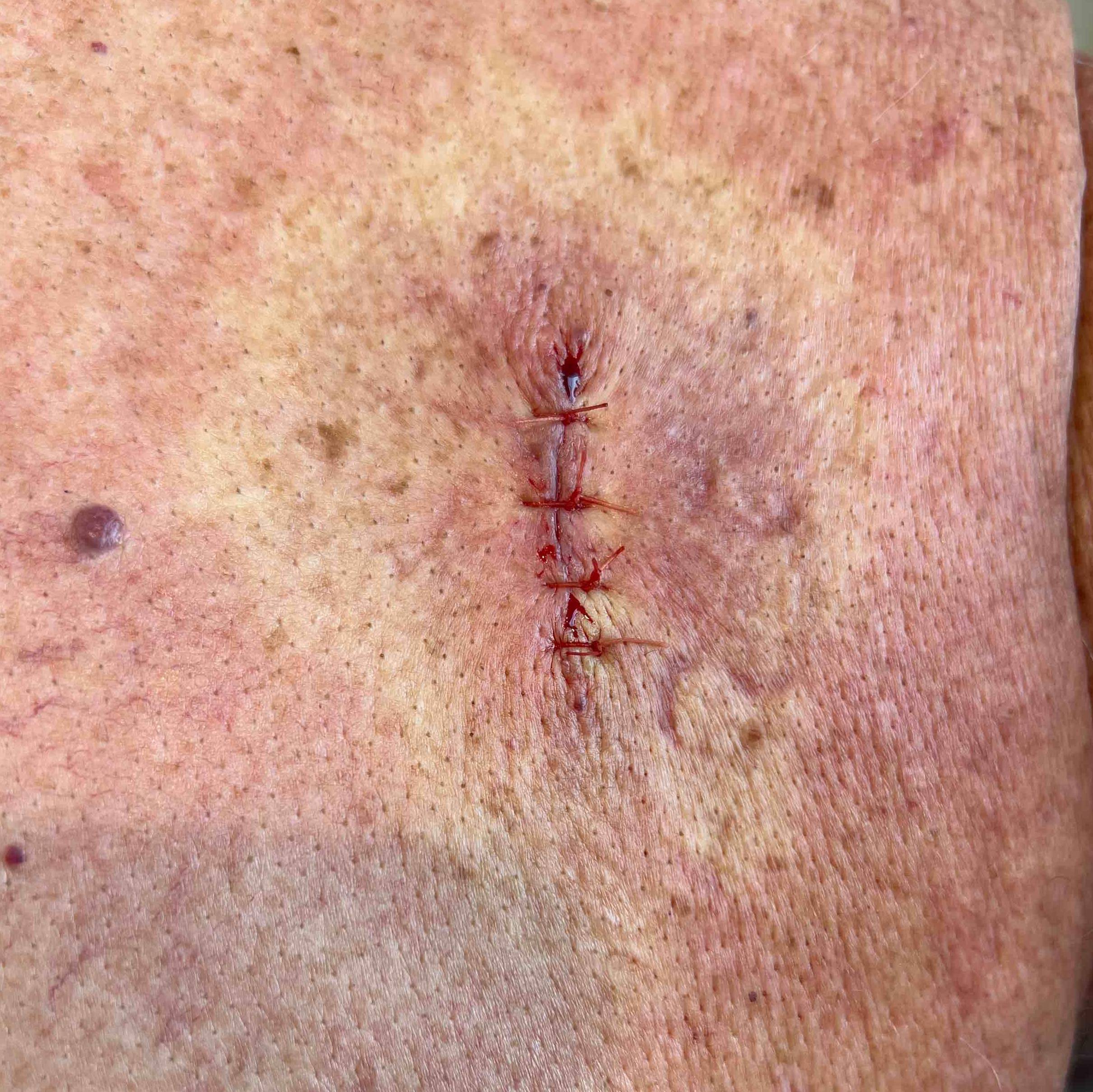 Cyst Removal Before and After Case 20 After