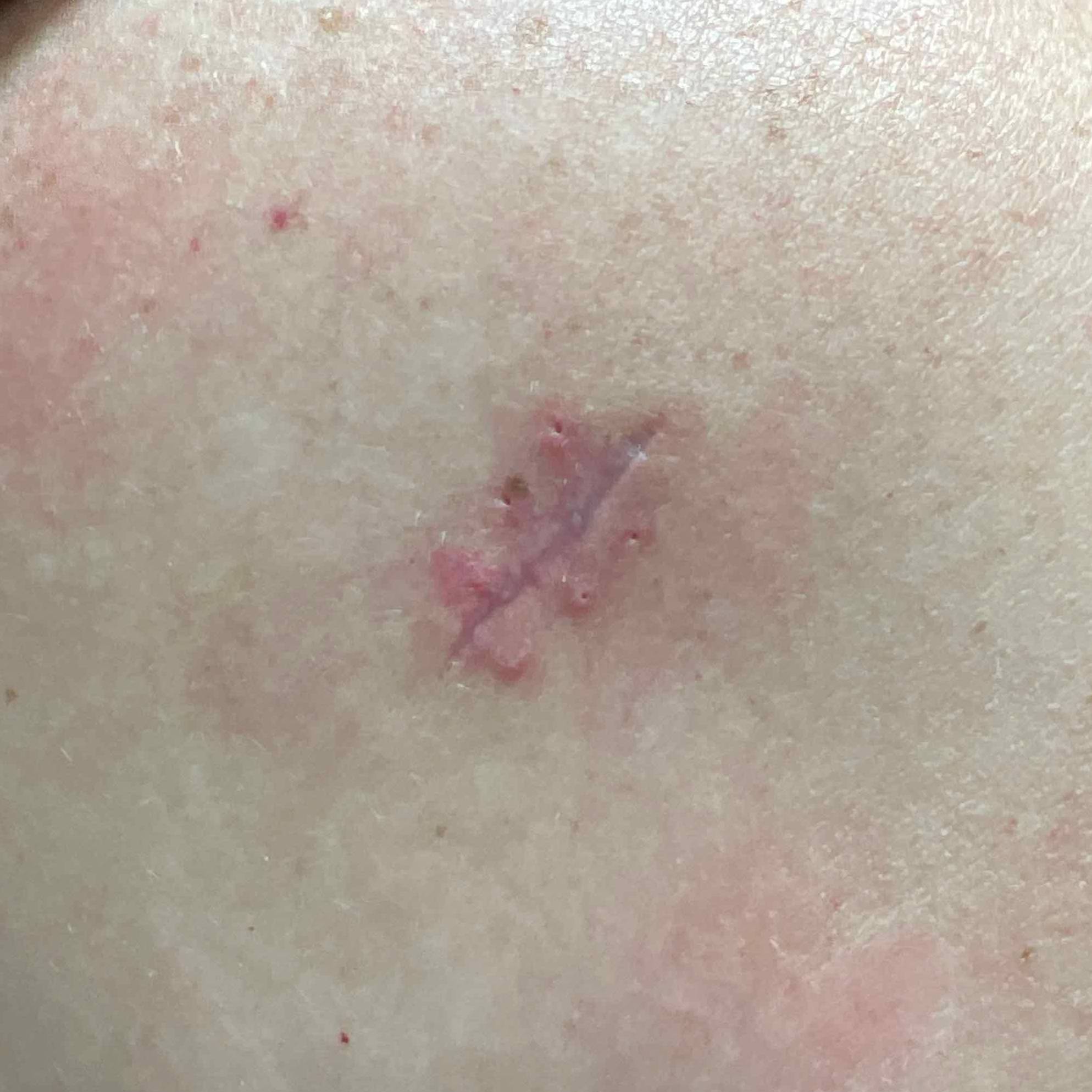 Cyst Removal Before and After Case 21 After