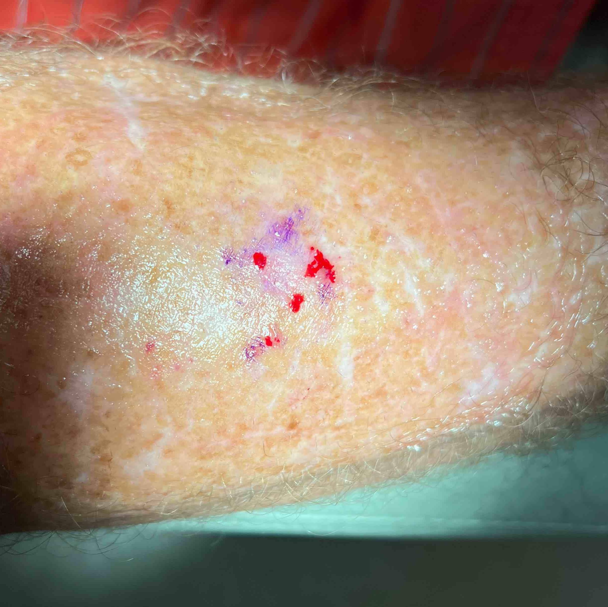 Skin Cancer Before and After Case 77 Before