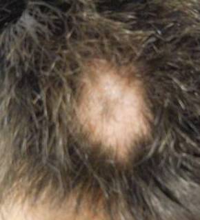 Hair Loss Before and After Case 3 Before