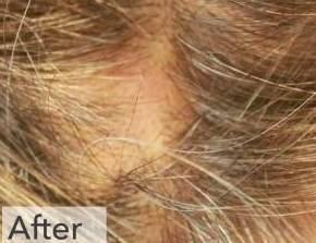 Hair Loss Before and After Case 4 After