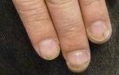 Fungus Before and After Case 2 After