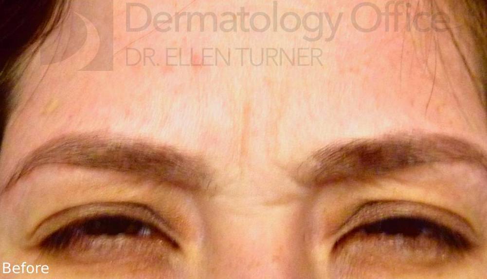 Xeomin (25 Units Glabella) Case-4 Before