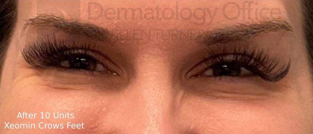 Xeomin (10 Units Crows Feet) Case-8 After