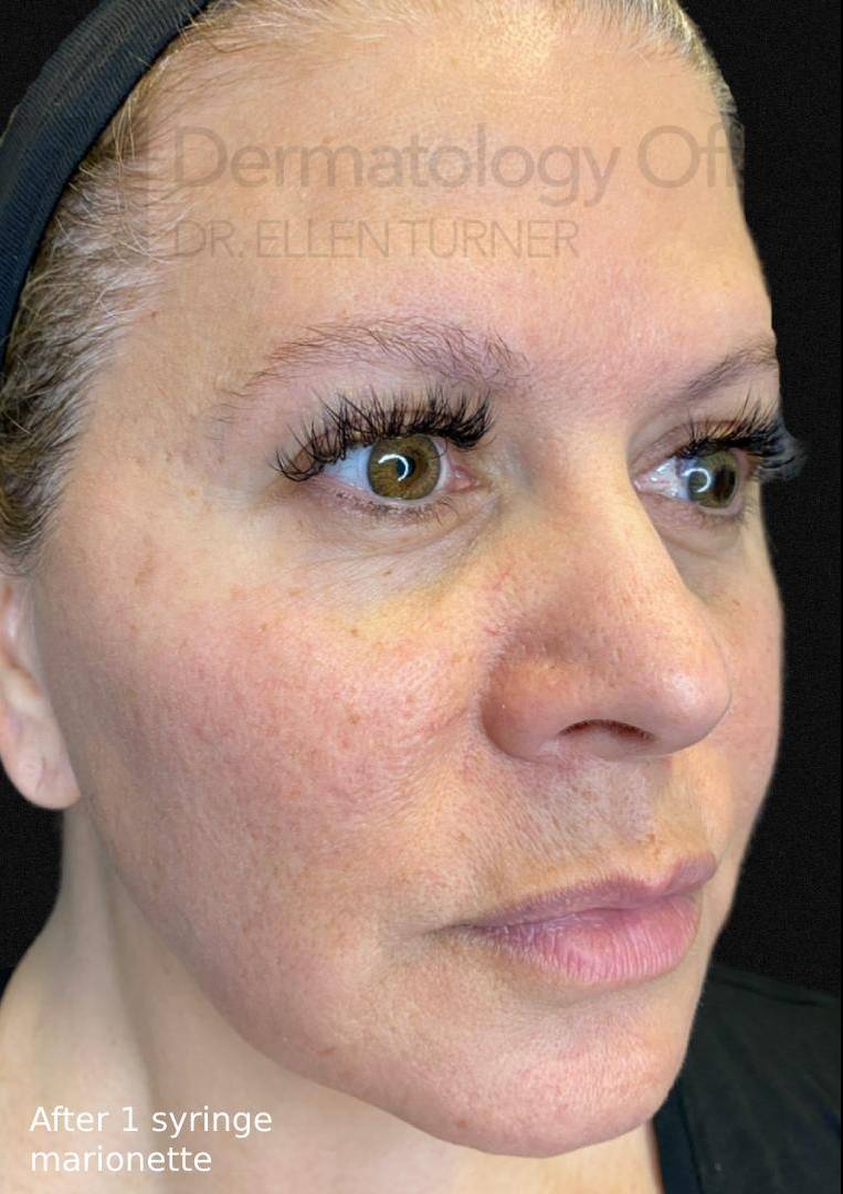 Juvederm (2 Syringes) Case-8 After