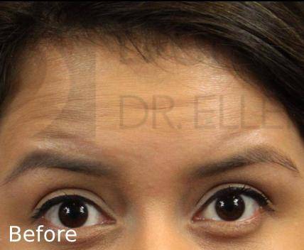 Botox (15 Units) Case 7 Before