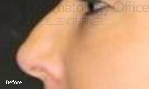 Injectable Rhinoplasty (1 Syringe) Before and After Case 1 Before