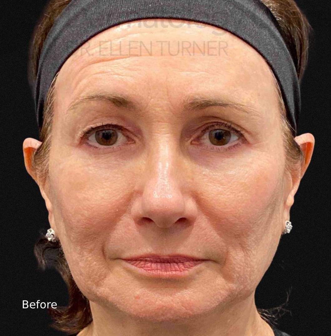 EMFACE (4 treatments) Before and After Case-8 Before