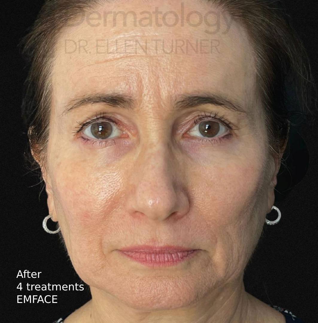 EMFACE (4 treatments) Before and After Case-8 After