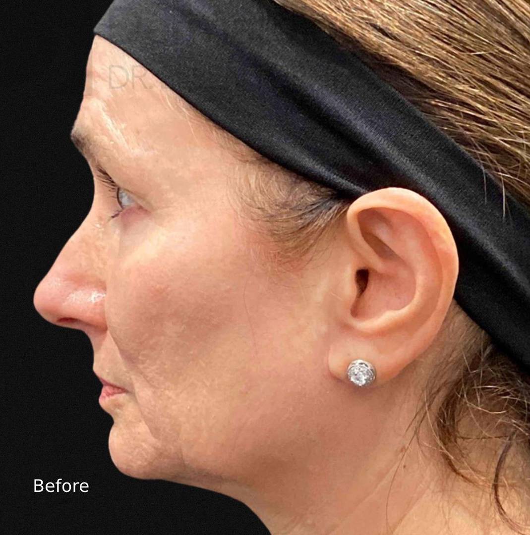 EMFACE (4 treatment) Before and After Case-9 Before