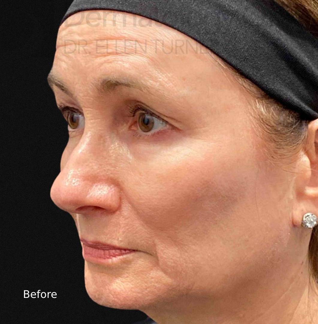 EMFACE (4 treatments) Before and After Case-10 Before